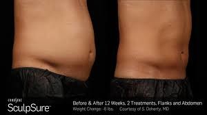 There is minimal, if any, downtime with SculpSure. This is a non-invasive and comfortable treatment.