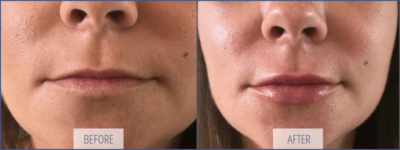 Which Filler is Best for Lip Augmentation?