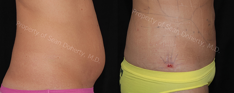Liposuction before & after photo patient