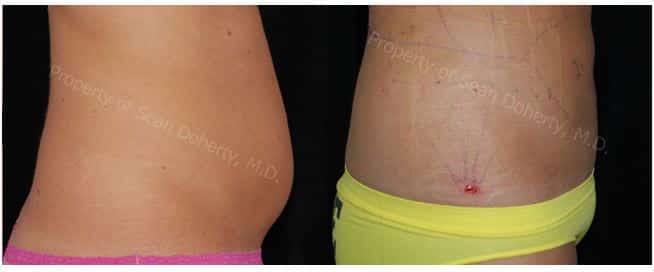 boston liposuction