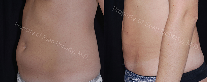 Liposuction before & after photo patient