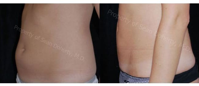 Liposuction in Boston, MA