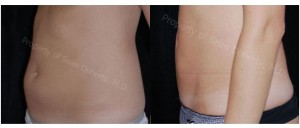 Who is the Best Candidate for Liposuction?