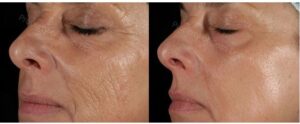 Discover a Better Non-Invasive Facelift Procedure