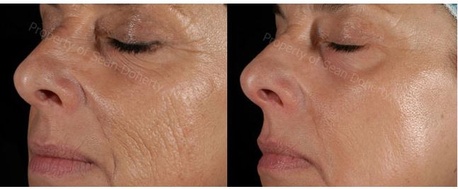 non-invasive facelift Boston