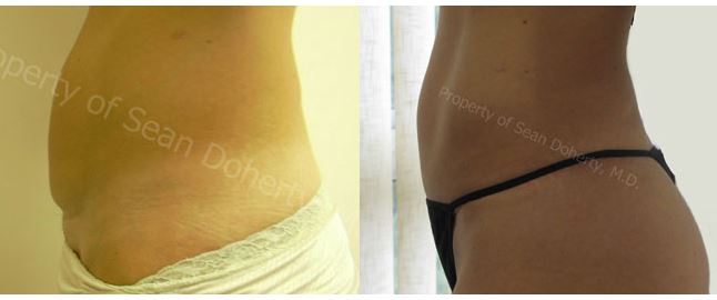 tummy tuck boston