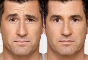 Botox for Men: The Latest and Most Popular Anti-Aging Trend