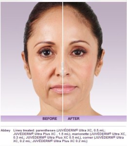 Juvederm Voluma Boston