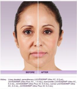 Juvederm Voluma: The Latest Anti-Aging Innovation