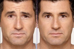 male botox Boston