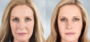 Sculptra Youthful Results Without The Face Lift