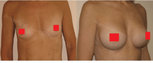 breast augmentation boston