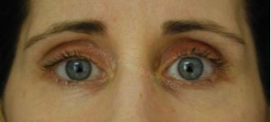 non-surgical eye treatments