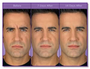 Botox for Men’s Eyes