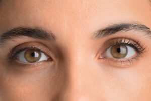 Close-up of eyes representing deep tear trough treatment for under-eye bags and shadows.
