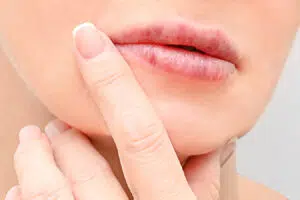 Close-up of lips representing natural lip augmentation with subtle, balanced volume.