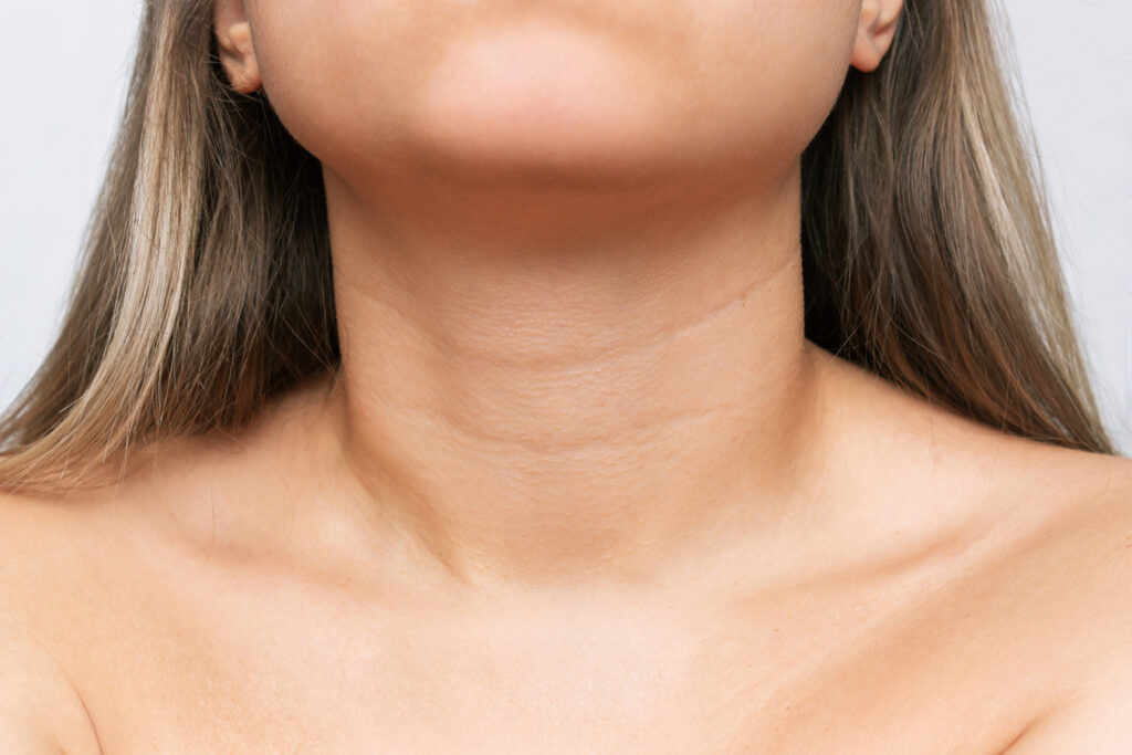 Close-up of neck lines representing treatment options for neck bands and necklace lines.