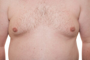 Male chest showing excess tissue representing gynecomastia surgery for a flatter chest contour.