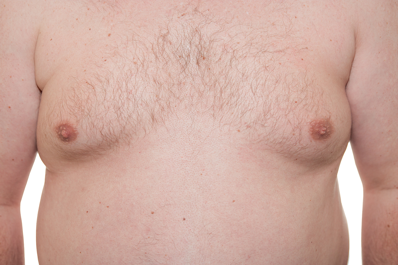 Male chest showing excess tissue representing gynecomastia surgery for a flatter chest contour.