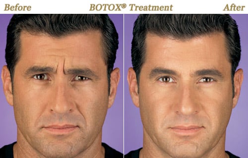 Botox for Men Before & After 