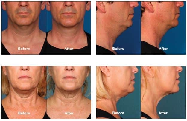 Kybella before & after photos