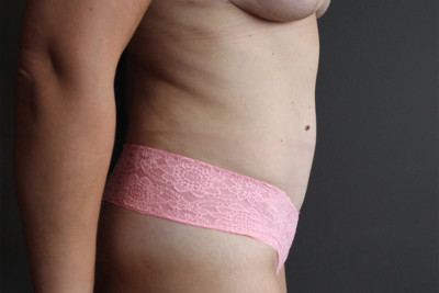tummy-tuck-lat-r-boston-after Tummy Tuck Lateral Right After