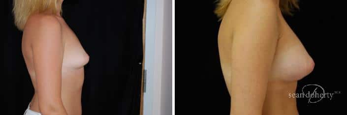 Patient 2327, Breast Augmentation Before and After Photos Breast Augmentation Before and After Photos in Boston, MA, Patient 2327