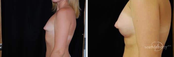 Patient 2327, Breast Augmentation Before and After Photos Breast Augmentation Before and After Photos in Boston, MA, Patient 2327