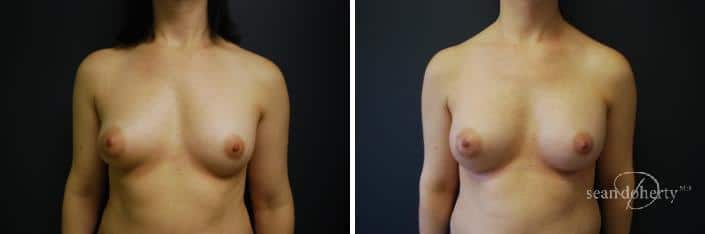 Breast Implant Exchange Before and After Photos in Boston, MA, Patient 2421