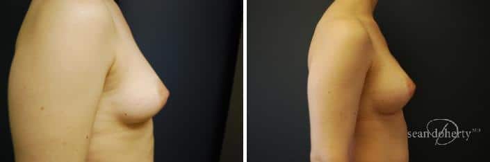 Breast Implant Exchange Before and After Photos in Boston, MA, Patient 2421