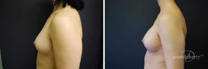 Breast Implant Exchange Before and After Photos in Boston, MA, Patient 2421