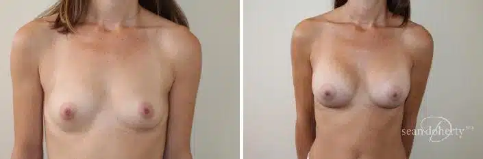 Breast Augmentation Before and After Photos in Boston, MA, Patient 2428