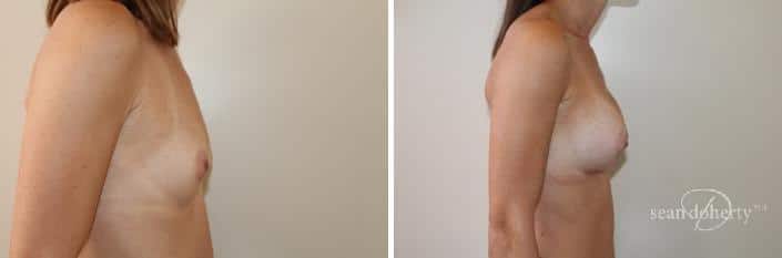 Breast Augmentation Before and After Photos in Boston, MA, Patient 2428