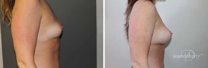 Patient 2374, Breast Augmentation Before and After Photos Breast Augmentation Before and After Photos in Boston, MA, Patient 2374
