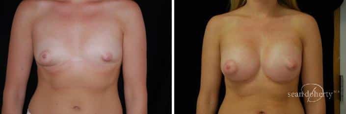 Patient 2327, Breast Augmentation Before and After Photos Breast Augmentation Before and After Photos in Boston, MA, Patient 2327