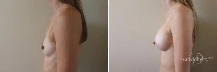 Breast Augmentation Before and After Photos in Boston, MA, Patient 2379