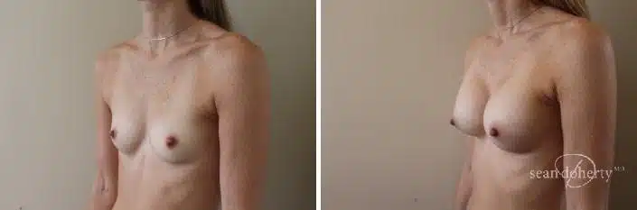 Breast Augmentation Before and After Photos in Boston, MA, Patient 2379