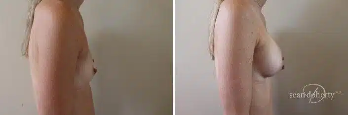 Breast Augmentation Before and After Photos in Boston, MA, Patient 2379