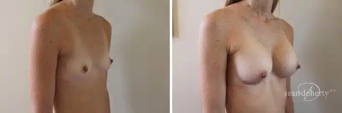 Breast Augmentation Before and After Photos in Boston, MA, Patient 2379