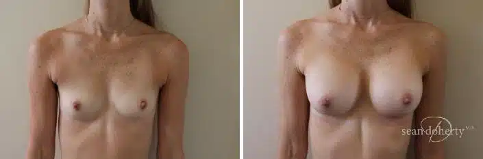Breast Augmentation Before and After Photos in Boston, MA, Patient 2379