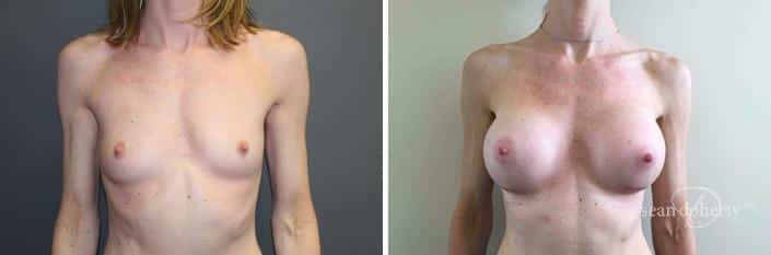 Patient 2400, Breast Augmentation Before and After Photos Breast Augmentation Before and After Photos in Boston, MA, Patient 2400