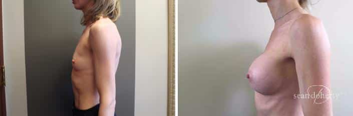 Patient 2400, Breast Augmentation Before and After Photos Breast Augmentation Before and After Photos in Boston, MA, Patient 2400