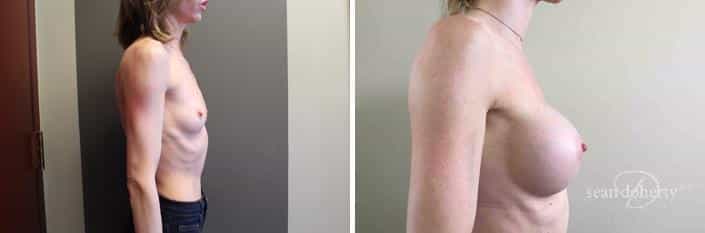 Patient 2400, Breast Augmentation Before and After Photos Breast Augmentation Before and After Photos in Boston, MA, Patient 2400
