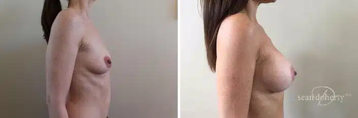 Patient 2410, Breast Augmentation Before and After Photos Breast Augmentation Before and After Photos in Boston, MA, Patient 2410