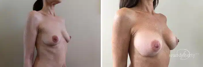 Patient 2410, Breast Augmentation Before and After Photos Breast Augmentation Before and After Photos in Boston, MA, Patient 2410