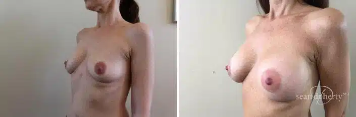 Patient 2410, Breast Augmentation Before and After Photos Breast Augmentation Before and After Photos in Boston, MA, Patient 2410