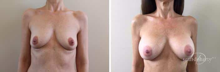 Patient 2410, Breast Augmentation Before and After Photos Breast Augmentation Before and After Photos in Boston, MA, Patient 2410