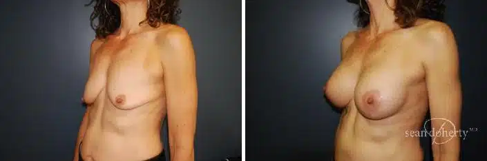 Breast Lift with Implants Before and After Photos in Boston, MA, Patient 2445