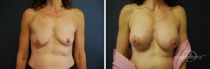 Breast Lift with Implants Before and After Photos in Boston, MA, Patient 2445