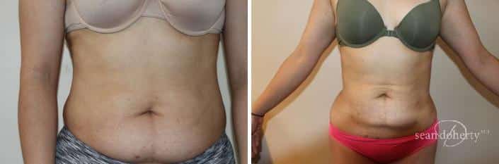 Patient 2462, Liposuction before and after photos Liposuction before and after photos in Boston, MA, Patient 2462